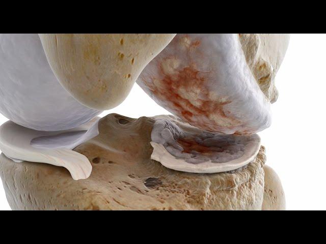 Kniearthrose.  Arthrose - Medizinische 3D Animation von CAT MEDIC