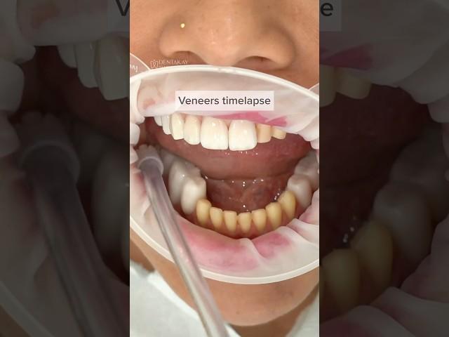 Veneers Placement Timelapse: Watch This Step-by-Step Guide for a Perfect Smile #shorts #Timelapse