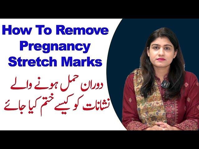 How To remove Pregnancy Stretch Marks