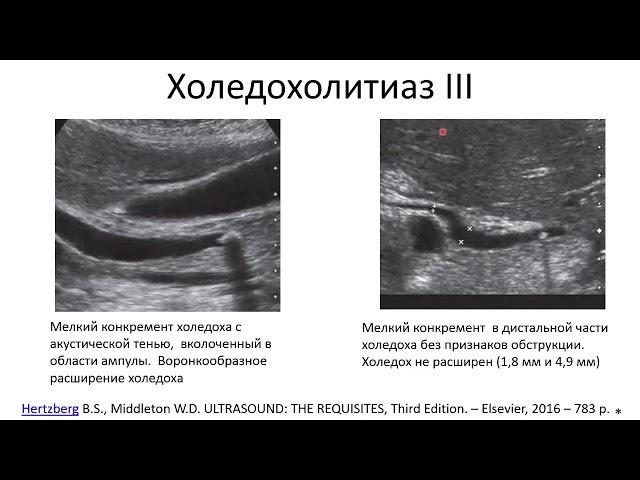 Эхосемиотика структурных изменений желчного пузыря и желчных путей. Часть 2.