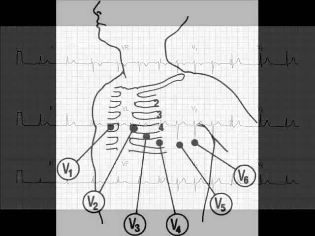 Master the basic steps of ECG (EKG) interpretation - Session 1