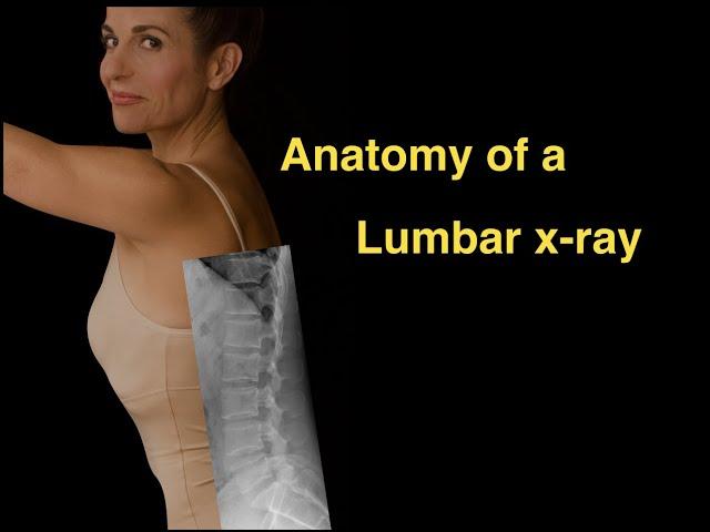 Anatomy of a Lumbar x-ray