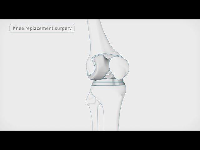 How is a knee replacement performed | Spire Healthcare