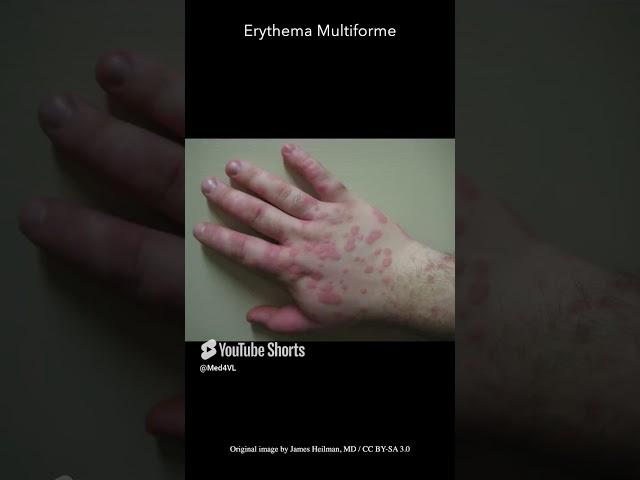 Erythema Multiforme