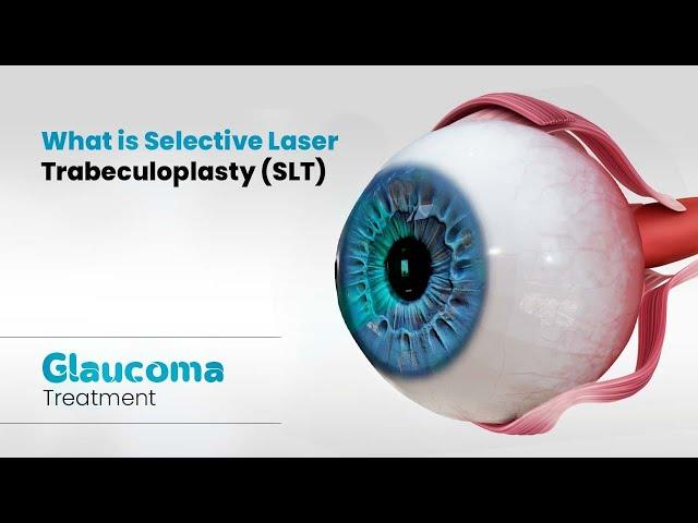 What is Selective Laser Trabeculoplasty (SLT) | Glaucoma Treatment (3D)