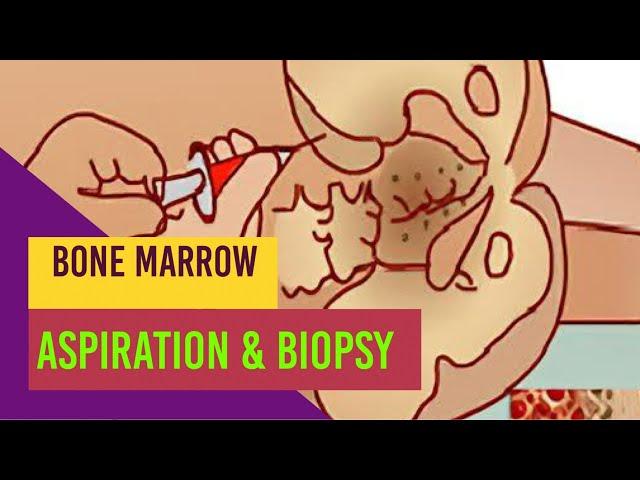 Bone marrow aspiration and biopsy/Process/Indications/Medschool simplified