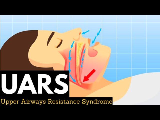 Upper Airway Resistance Syndrome (UARS)