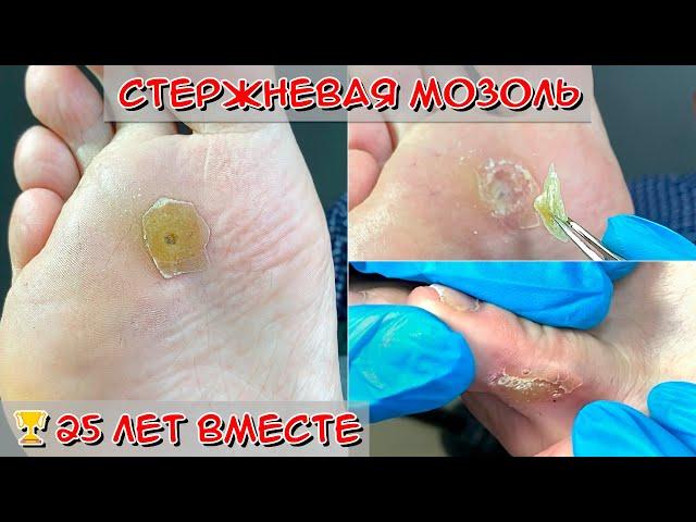 Removal of calluses on the foot / Interdigital callus