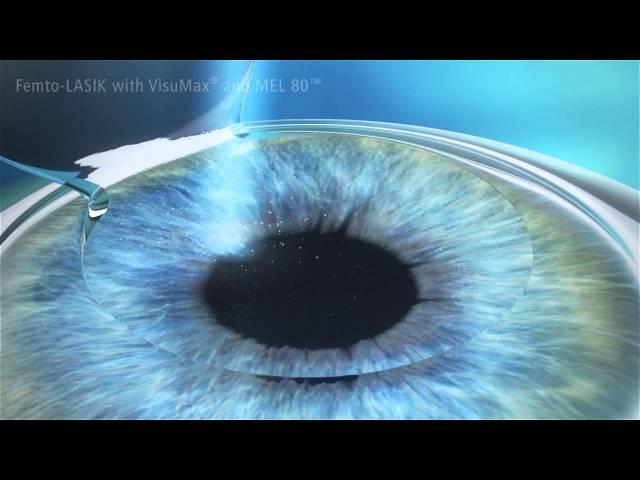 Augenlasern mit dem Verfahren Femto-Lasik