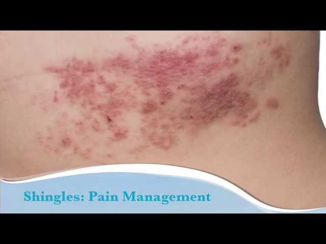 How to treat shingles