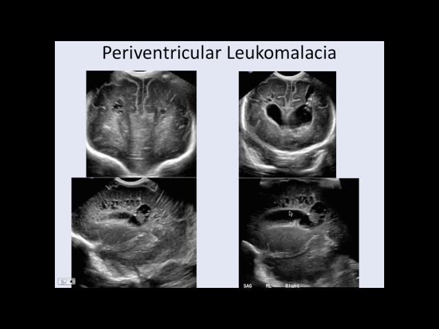 Cranial Ultrasound Potpourri