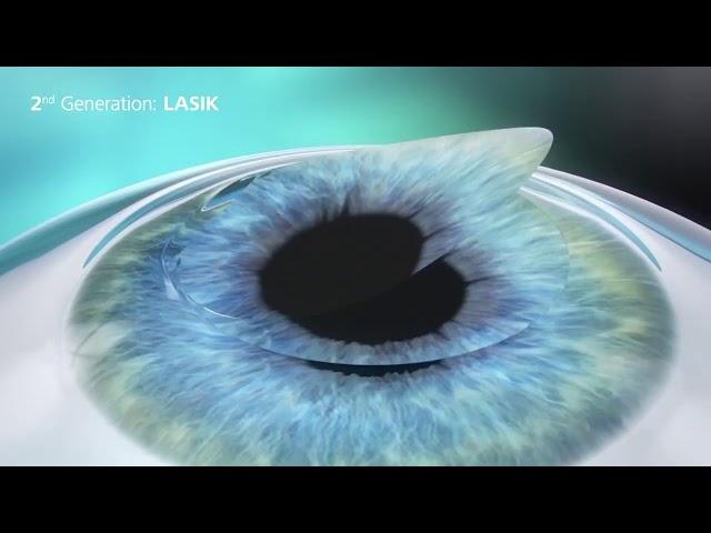 Операция ReLEx SMILE  - новейшая лазерная коррекция зрения 