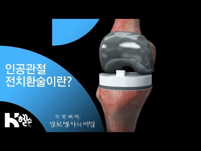 인공관절전치환술이란? - (20181219_675회 방송) 100세까지 걷고 싶다 - 극복! 퇴행성관절염