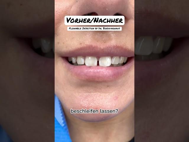 🫦Flowable Injection Technique by Dr. Boeddinghaus #flowableinjection #zahnarzt #schönezähne #veneer