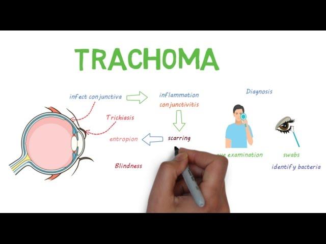 Trachoma - a devastating infectious eye disease