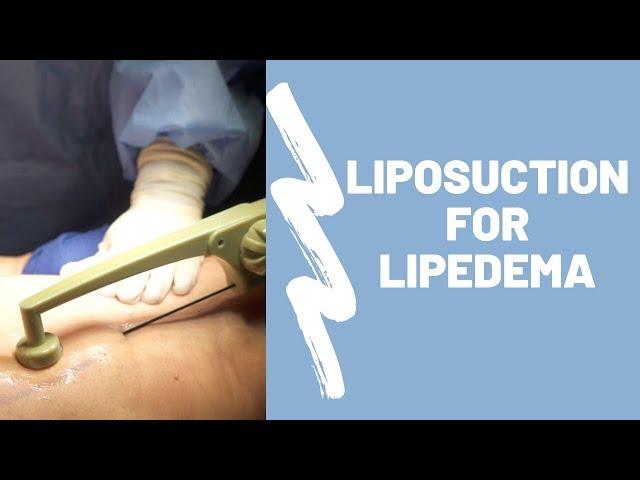 Liposuction for Lipedema Procedure Breakdown