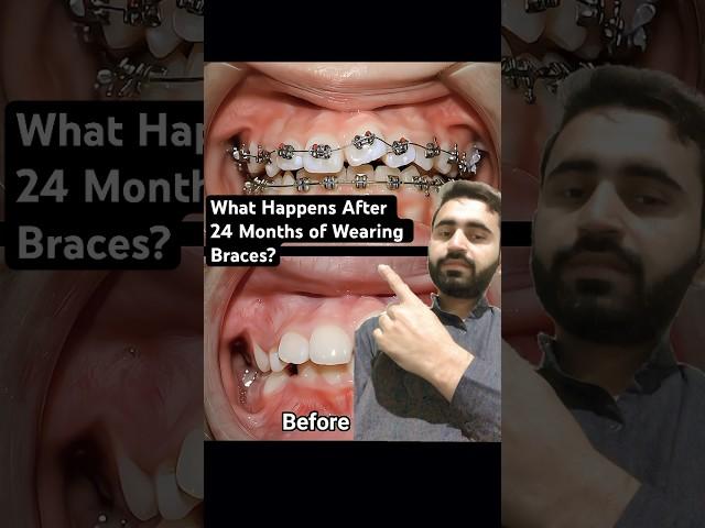 What Happens After 24 Months of Wearing Braces?#dentist #braces #orthodontist #dentistry