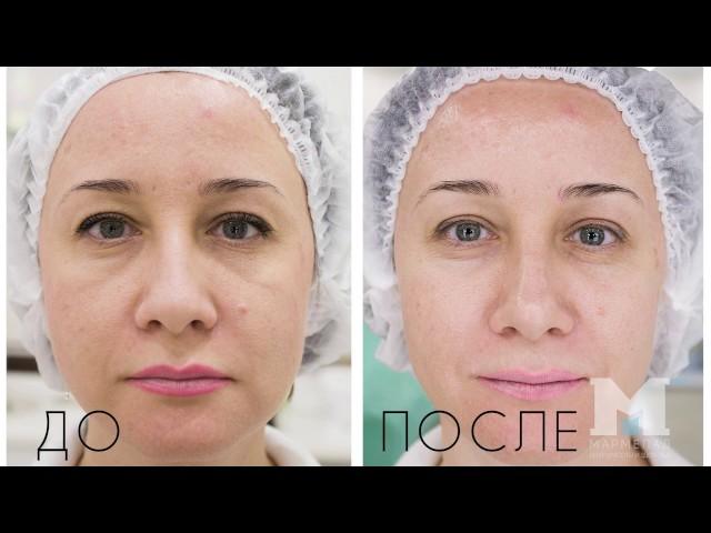 Газожидкостный пилинг Jet Clear в Мармелад.PRO