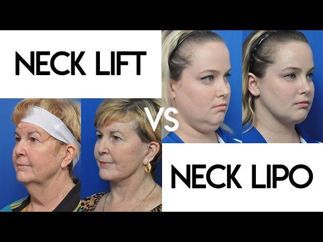 Neck Lift vs Neck Lipo