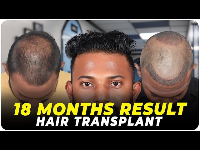 Hair Transplant in Vizag | Best Results & Cost of Hair Transplant in Vizag