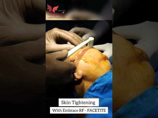 Skin Tightening with Embrace Rf Facetite for Facial Rejuvenation & Youthful Skin