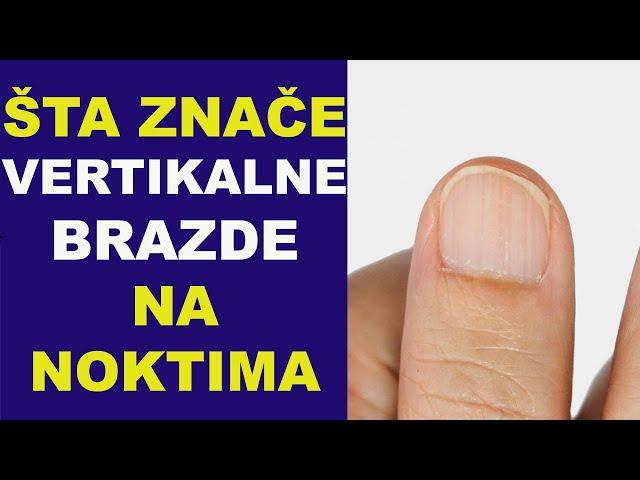 Šta znače VERTIKALNE BRAZDE NA NOKTIMA/dr Bojana Mandić