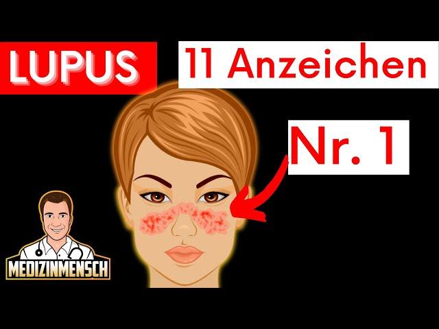 Autoimmunkrankheit Lupus erkennen (SLE, Rheumatologe erklärt Symptome)