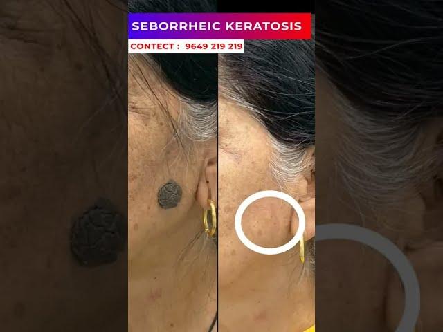 Seborrheic Keratosis treatment at Skinaa clinic #viralshorts  #serborrheic_keratosis #skinaaclinic