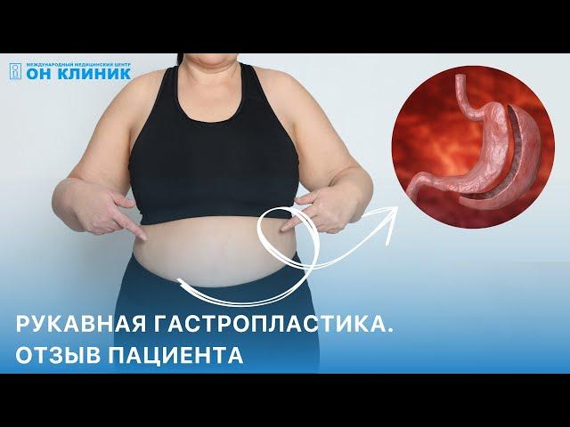 Рукавная гастропластика. Отзыв пациента