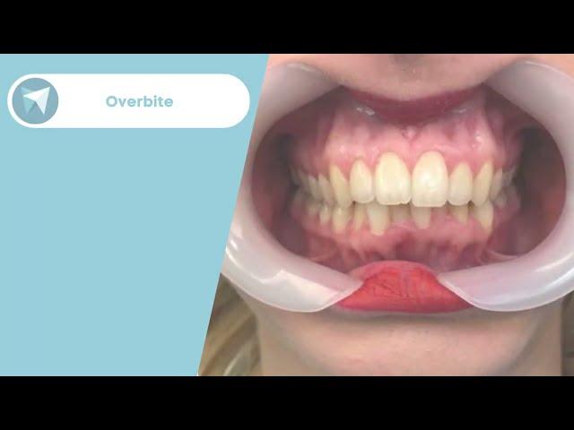 Overbite Treatment Before / After - Forest & Ray - Dentists, Orthodontists, Implant Surgeons