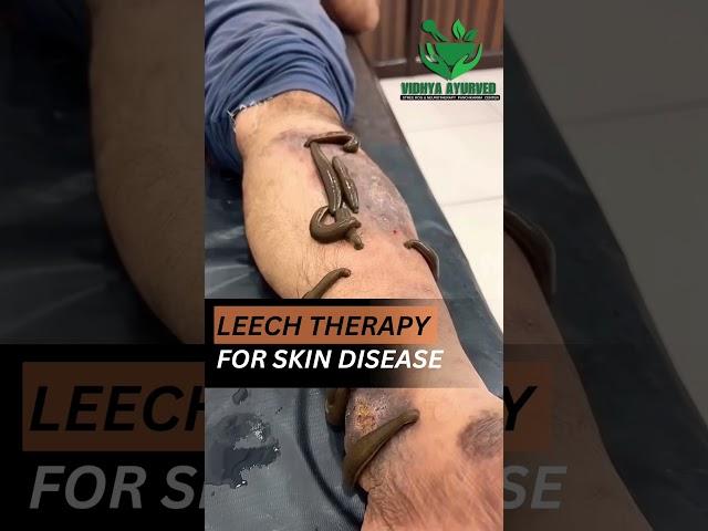 leech tharapy in skin disease aczema, psoriasis,acne, malasma, #drdeepikapatidar #leechtherapy