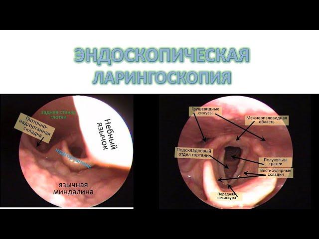 ЭНДОСКОПИЧЕСКАЯ ЛАРИНГОСКОПИЯ НОРМА  лор-хирург к.м.н. Фуки Евгений Михайлович