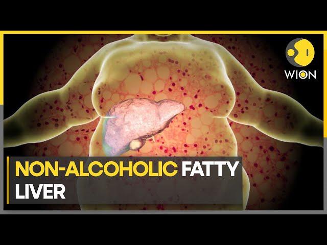 Unhealthy eating habits & lifestyle can cause fatty liver | World News | WION