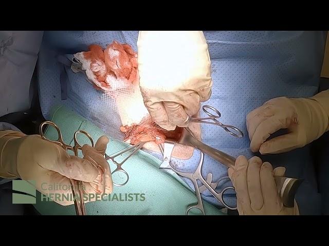 Open Inguinal Hernia Repair at California Hernia Specialists (4K)