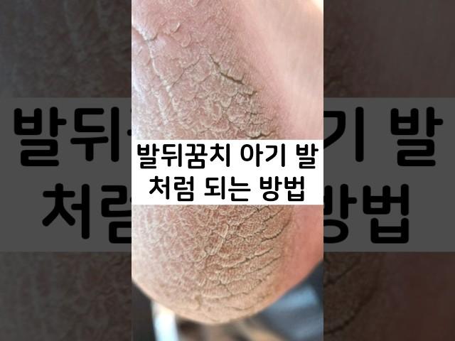 발뒤꿈치 아기 발처럼 되는 방법, 발뒤꿈치 갈라짐