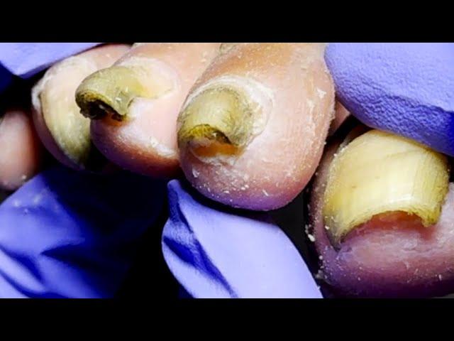 Contagious Onychomycosis, Trim It Clean~【Dr  Liu's Pedicur】