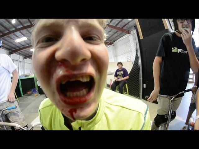 EPIC FACEPLANT !!! BROKEN TEETH !!!