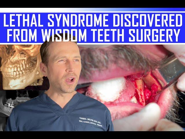 LETHAL SYNDROME DISCOVERED from WISDOM TEETH