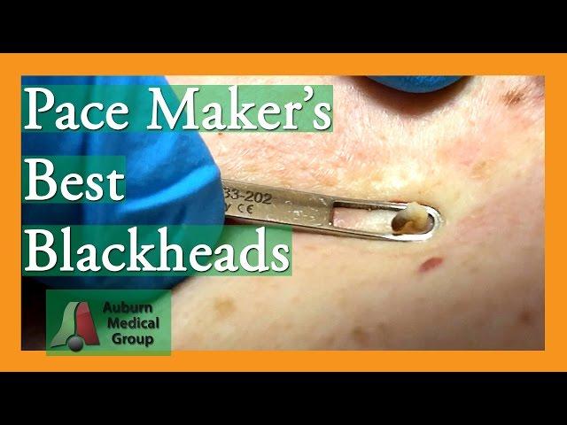 Best of Pace Maker's Blackheads Removed #popping | Auburn Medical Group