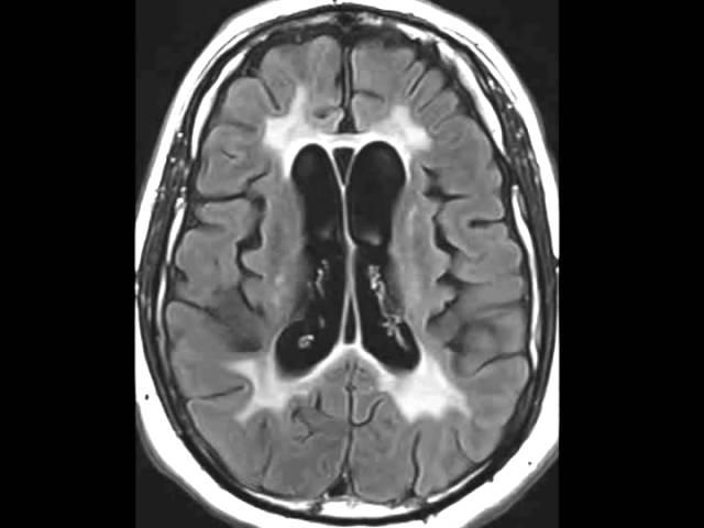 HIV Leukoencephalopathy