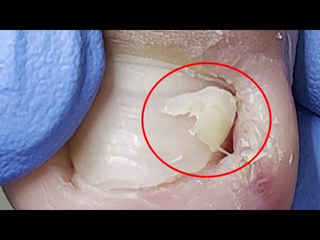 Huge ingrown nails & toenails heal quickly【Xue Yidao】