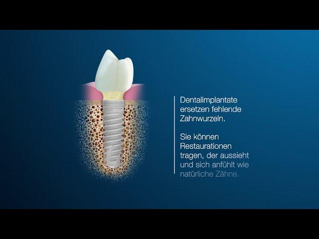 Was sind Zahnimplantate?