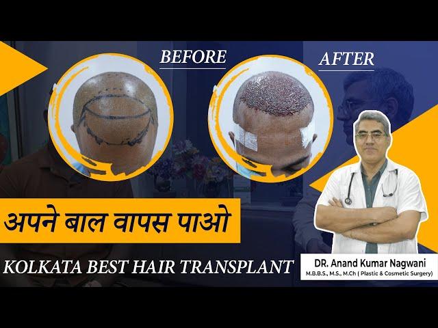 BEST HAIR TRANSPLANT SURGERY IN KOLKATA |  FUT HAIR TRANSPLANT