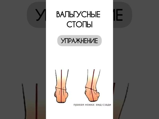 Вальгусные стопы #вальгусудетей #впльгусныестопы #вальгус