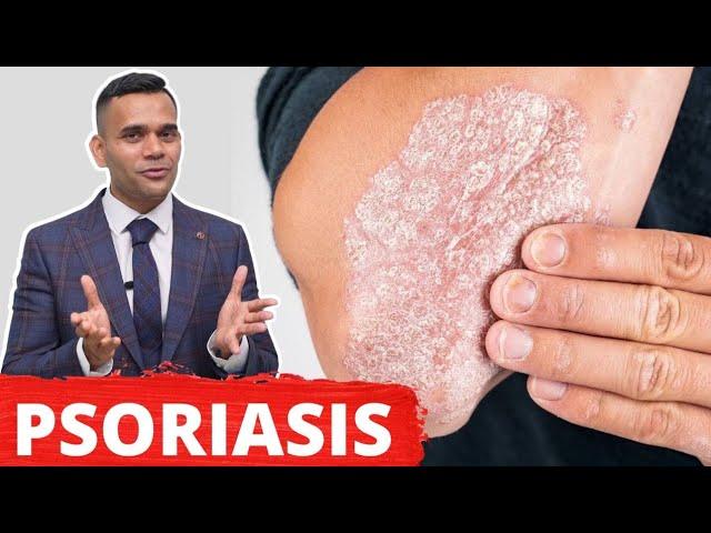 Psoriasis Treatment - The Best 2 Remedies For Psoriasis