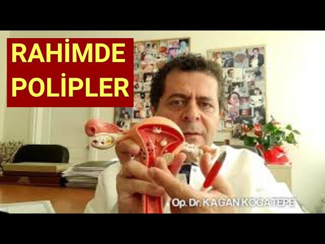 RAHİMDE POLİP NEDİR, NASIL TANI KONUR, NASIL TEDAVİ EDİLİR,NE ŞİKAYETE YOL AÇAR,AMELİYAT GEREKİR Mİ?