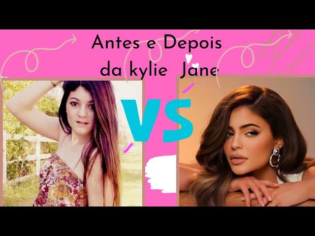 olha esse antes e Depois da Kylie jenne antes #e #depois #da  #famosos #antesedepois #brasil