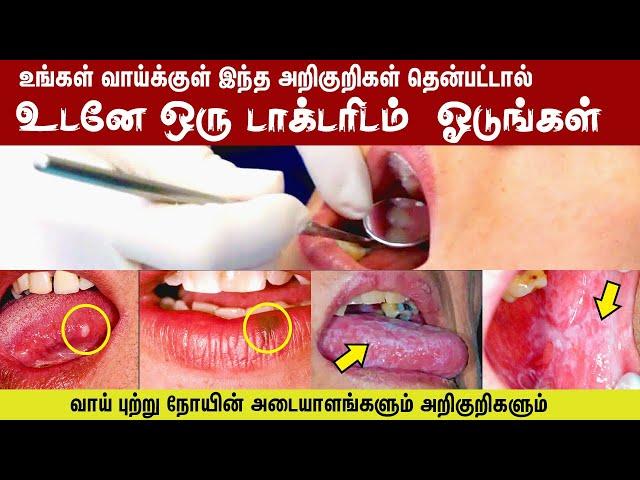 வாய் புற்று நோயின் அடையாளங்களும் அறிகுறிகளும் | SIGNS AND SYMPTOMS OF ORAL CANCER