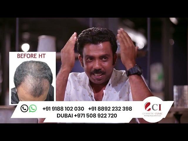 Hair Transplantation done by Malayalam Cine artist Azees Nedumangad