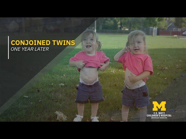 Formerly conjoined twins thriving as toddlers